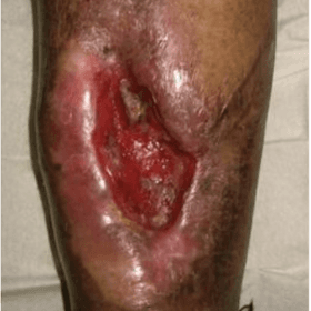 Wound Infections/Osteomyelitis(Bone Infection)/Cellulitis