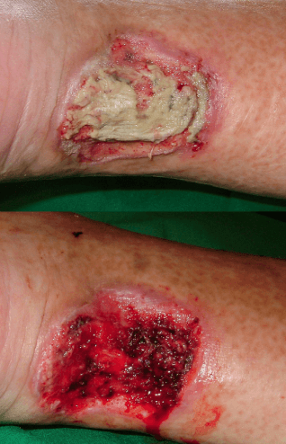 Surgical Debridement