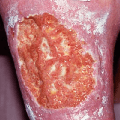 Venous Leg Ulcers