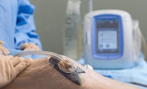 Negative Pressure Therapy (Wound VAC)