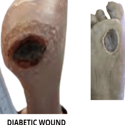 Diabetic Foot Ulcers