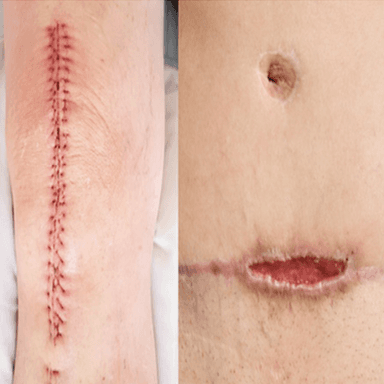 Surgical Wounds